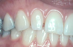 Before picture of a peg lateral defect on a tooth