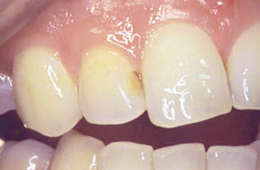 Before picture of a discolored tooth filling