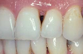 Periodontal gum defect between teeth