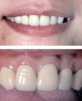 closeup of discolored dental crowns on woman