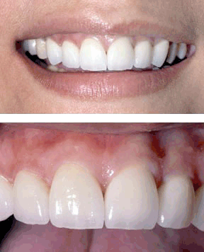 closeup of whitened dental crowns on woman