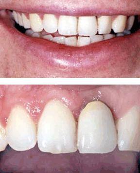 closeup of receded gum tissue on dental crown