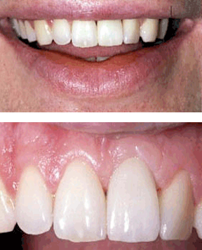 closeup of fixed dental gums on female patient