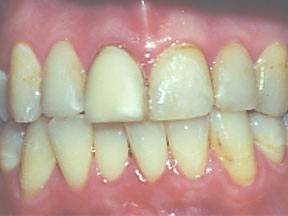 closeup of fake looking dental crown on patient