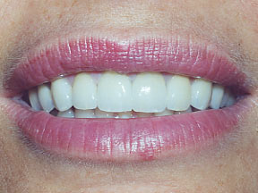 closeup of womans mouth with dental crowns and straight smile