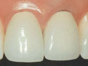 closeup of dental patient with gap in crown