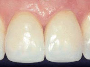 closeup of dental crown blended in with patient's gum