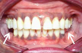 Dentures 1 - Before