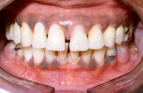 Dentures 1 - After