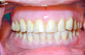 Dentures 2 - After