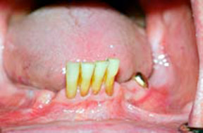 Dentures 3 - Before