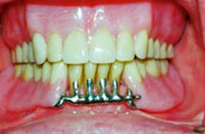 Dentures 3 - After