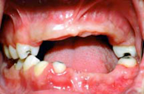 Dentures 4 - Before