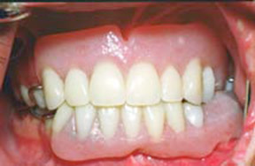Dentures 4 - After