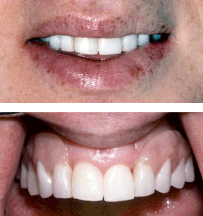 Dentures 5 - After