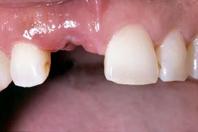 Closeup of dental patient with missing tooth