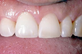 Closeup of dental patient with single dental implant