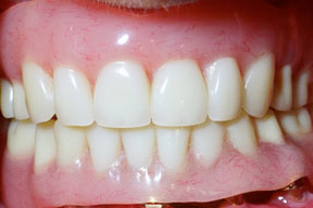 Closeup of dentures in mouth