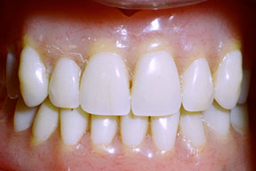 Closeup of dental patient with dental implants