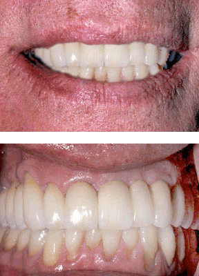 Closeup of patient with all on 6 dental implants