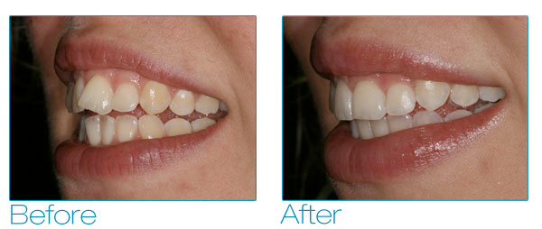 Six Month Smiles - Mindy Before & After 4