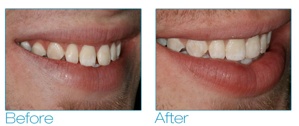 Six Month Smiles - Brennan Before & After 3