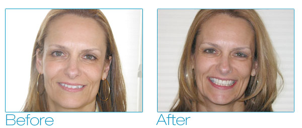 Six Month Smiles - Debra Before & After 1