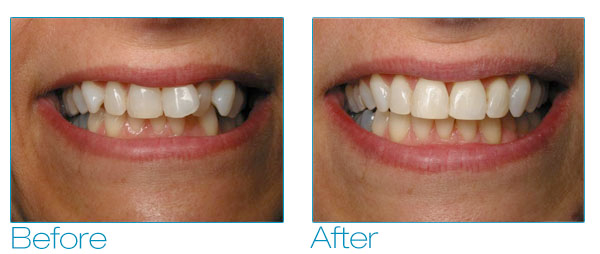 Six Month Smiles - Debra Before & After 2