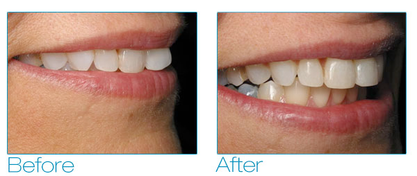Six Month Smiles - Debra Before & After 3