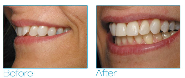 Six Month Smiles - Debra Before & After 4