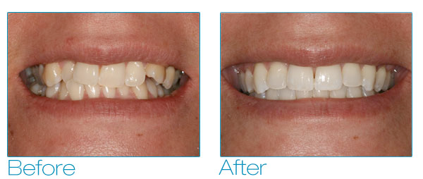 Six Month Smiles - Melissa Before & After 2