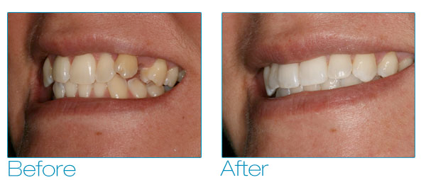 Six Month Smiles - Melissa Before & After 4